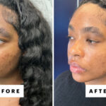 Does Laser Genesis Really Live Up to the Hype?