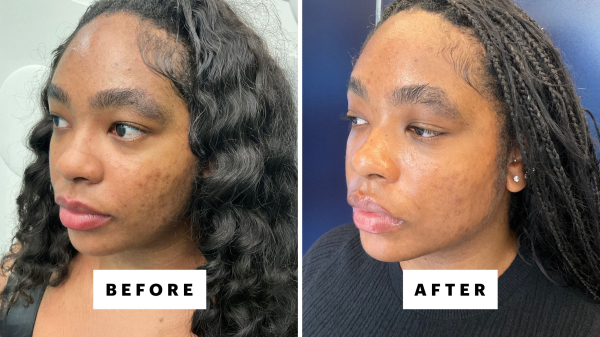 Does Laser Genesis Really Live Up to the Hype?