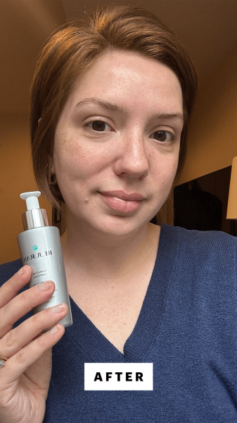 Silva after applying the Rejuran Dual Effect Ampoule