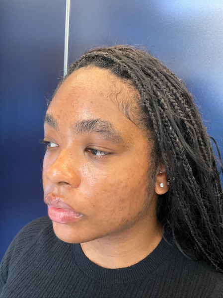 Laser Genesis before and before results on Black skin