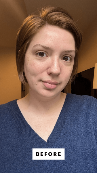 Silva before applying the Rejuran Dual Effect Ampoule